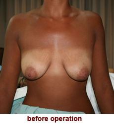 plastic-surgery-breast-lift-augmentation